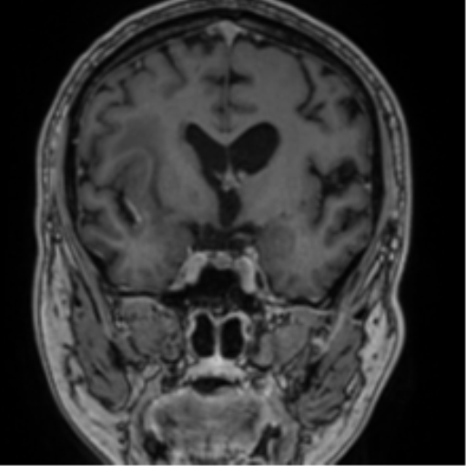 Atypical meningioma (WHO grade II) with brain invasion (Radiopaedia 57767-64729 Coronal T1 C+ 38).png