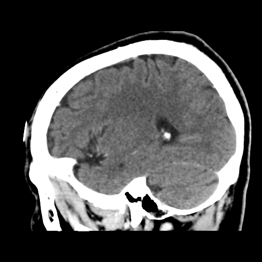 Atypical meningioma (WHO grade II) with osseous invasion (Radiopaedia 53654-59715 G 39).png