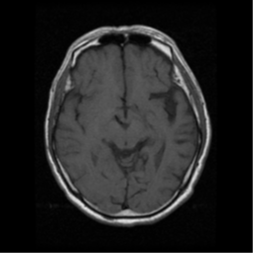 File:Atypical meningioma (WHO grade II) with osseous invasion (Radiopaedia 53654-59716 Axial T1 10).png