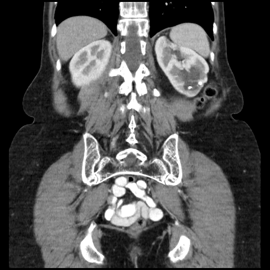 File:Atypical renal cyst (Radiopaedia 17536-17251 C 8).jpg