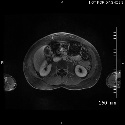 Autoimmune pancreatitis (Radiopaedia 88443-105101 A 84).jpg