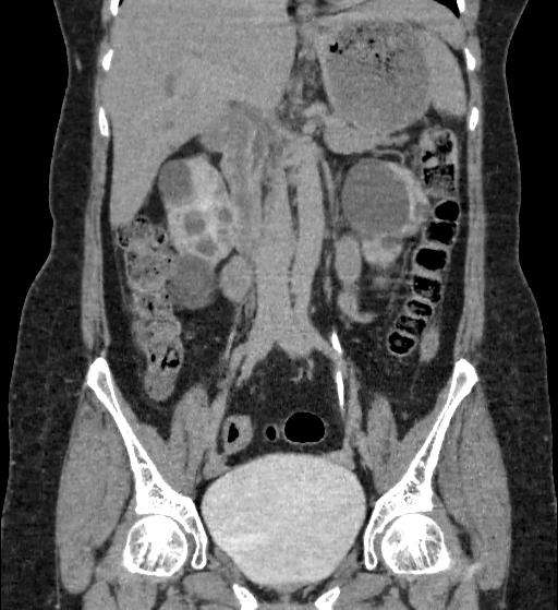 Autosomal dominant polycystic kidney disease (Radiopaedia 38189-40194 Coronal C+ delayed 40).jpg