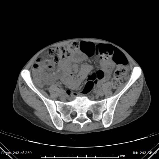 File:Autosomal dominant polycystic kidney disease (Radiopaedia 44122-47684 Axial 80).jpg