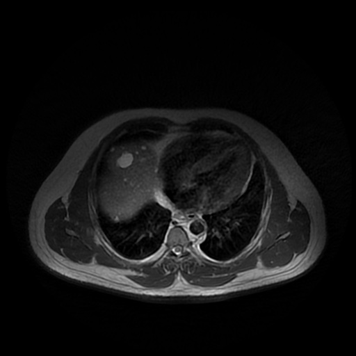 File:Autosomal dominant polycystic kidney disease (Radiopaedia 50259-55611 Axial T2 2).jpg