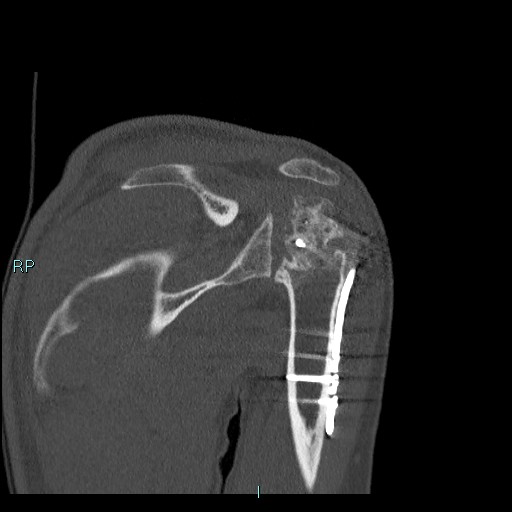 Avascular necrosis after fracture dislocations of the proximal humerus (Radiopaedia 88078-104655 Coronal bone window 67).jpg