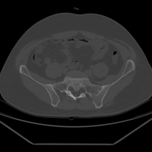 File:Avascular necrosis of the hip (Radiopaedia 61503-69467 Axial bone window 9).jpg