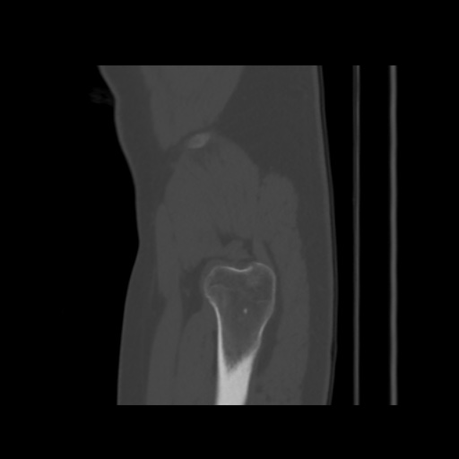 Avascular necrosis of the hip (Radiopaedia 61503-69467 B 57).jpg