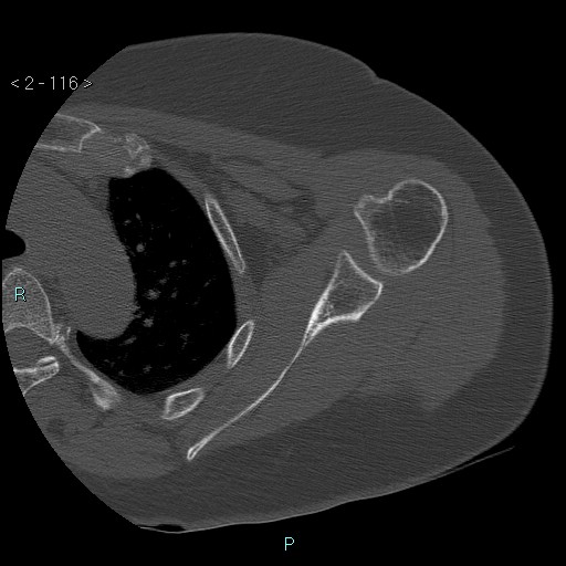 Avascular necrosis of the shoulder - Cruess stage I (Radiopaedia 77674-89887 Axial bone window 29).jpg