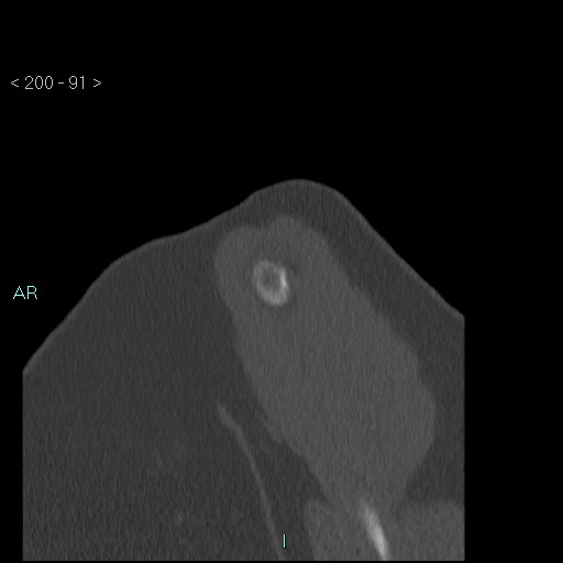File:Avascular necrosis of the shoulder - Cruess stage I (Radiopaedia 77674-89887 Sagittal bone window 90).jpg