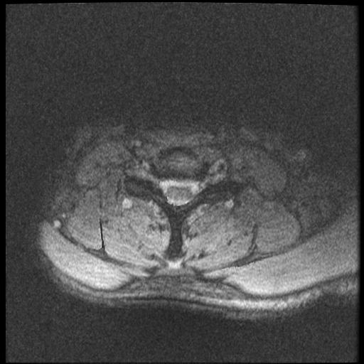 File:Axis fracture - MRI (Radiopaedia 71925-82375 Axial T2 fat sat 18).jpg