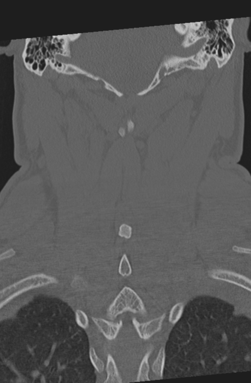 Axis peg fracture (type 3) and atlas lateral mass (type 4) fracture (Radiopaedia 37474-39324 Coronal bone window 44).png