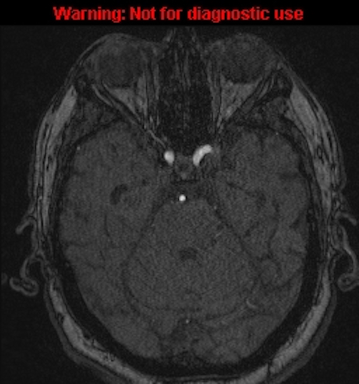 Azygos anterior cerebral artery (Radiopaedia 59325-66677 Axial MRA 52).jpg