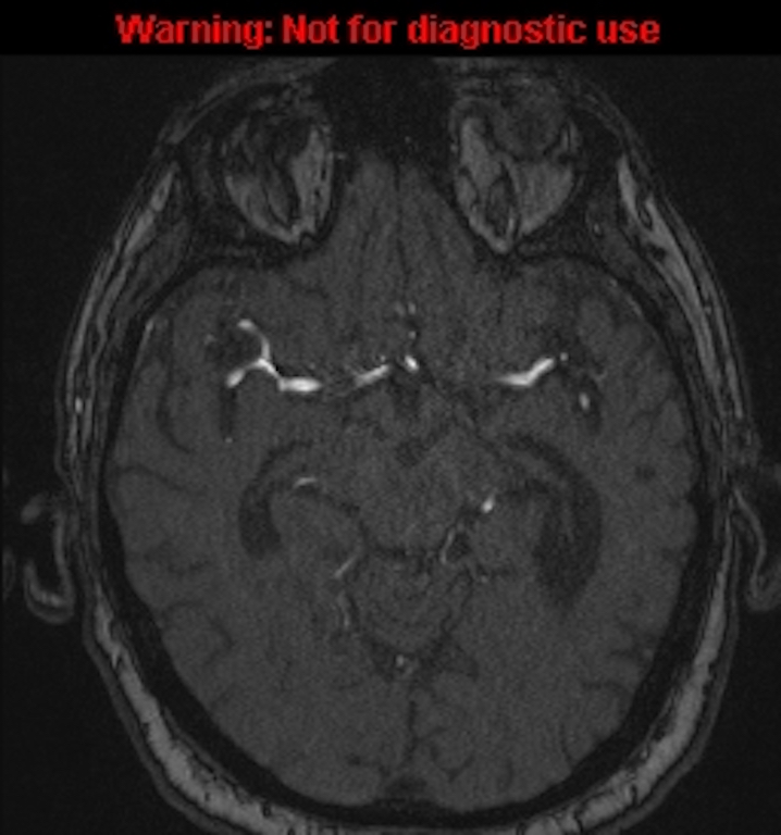 Azygos anterior cerebral artery (Radiopaedia 59325-66677 Axial MRA 70).jpg