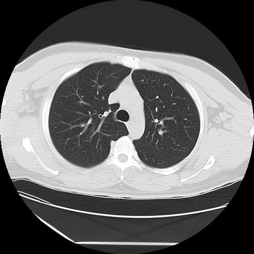 Azygos fissure (Radiopaedia 88181-104784 Axial lung window 15).jpg