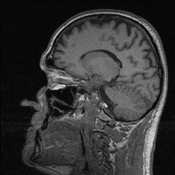 File:Balo concentric sclerosis (Radiopaedia 50458-55940 Sagittal T1 95).jpg