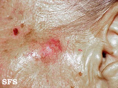 Basal Cell Carcinoma (Dermatology Atlas 33).jpg