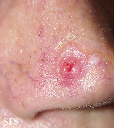 Basal Cell Carcinoma (Dermatology Atlas 88).jpg