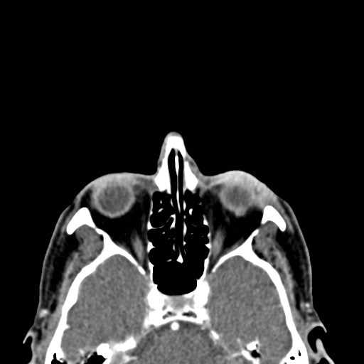 File:Basal cell carcinoma (periocular with orbital invasion) (Radiopaedia 30974-31672 Axial Postcontrast 16).jpg