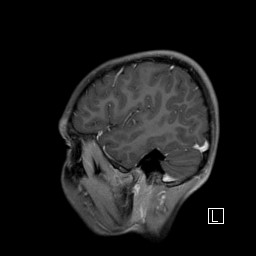 Base of skull rhabdomyosarcoma (Radiopaedia 32196-33142 J 49).jpg