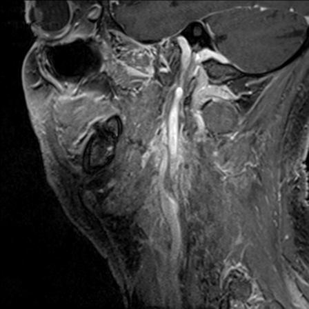 Base of tongue squamous cell carcinoma (Radiopaedia 31174-31884 F 49).jpg