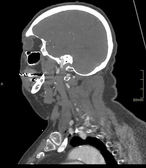 Basilar artery aneurysm (Radiopaedia 56261-62932 C 52).jpg