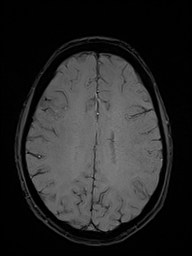 Basilar artery perforator aneurysm (Radiopaedia 82455-97733 Axial SWI 40).jpg
