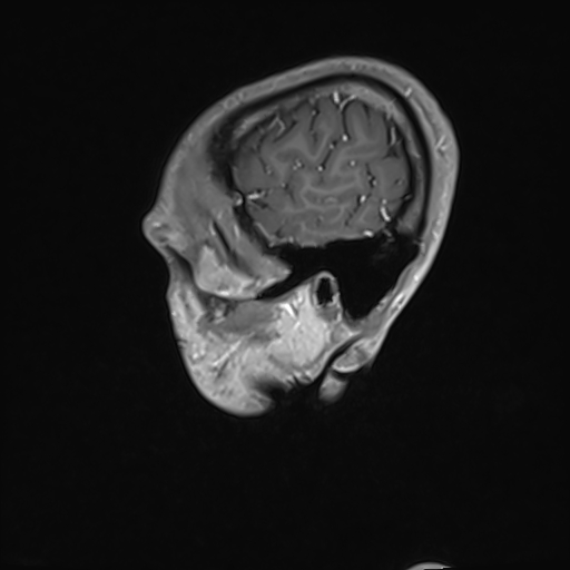 Basilar artery perforator aneurysm (Radiopaedia 82455-97733 G 19).jpg