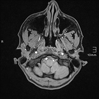 Basilar artery perforator aneurysm (Radiopaedia 82455-99523 F 1).jpg