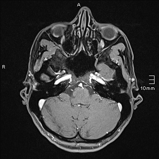 Basilar artery perforator aneurysm (Radiopaedia 82455-99523 G 23).jpg