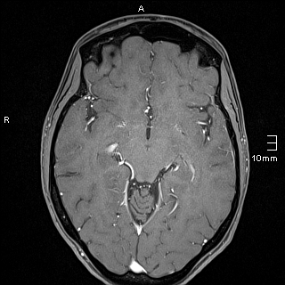 Basilar artery perforator aneurysm (Radiopaedia 82455-99523 G 65).jpg
