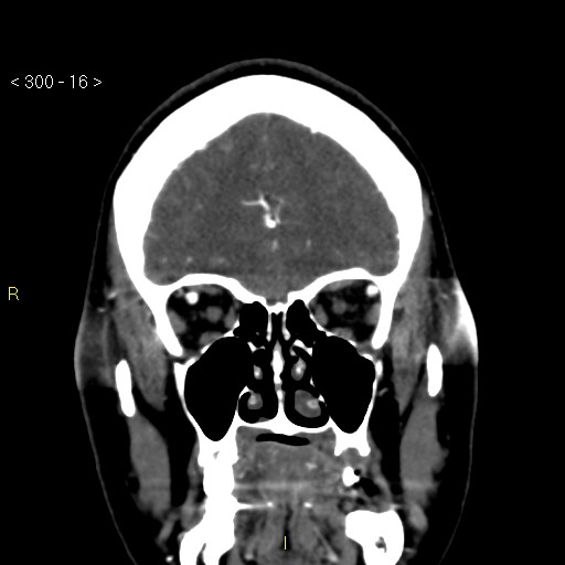 Basilar artery thrombosis (Radiopaedia 16260-15944 B 7).jpg