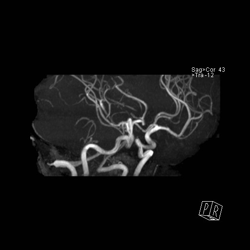 Basilar tip aneurysm (Radiopaedia 26504-26632 D 42).jpg
