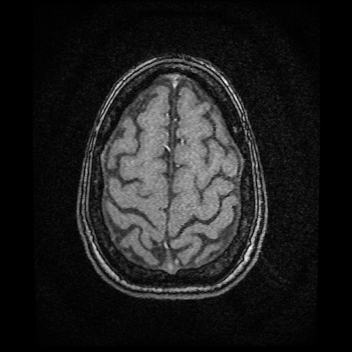 Basilar top and left middle cerebral artery aneurysm (Radiopaedia 61965-70031 Axial MRA 149).jpg