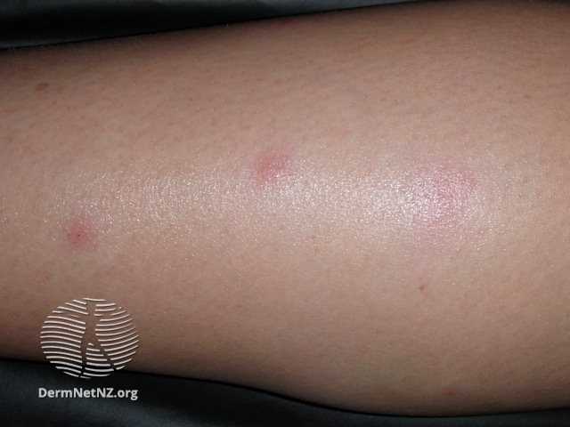 File:Bed bug bites (DermNet NZ arthropods-bedbug-bite2).jpg