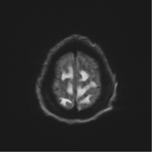 Behavioral variant frontotemporal dementia and late onset schizophrenia (Radiopaedia 52197-58083 Axial DTI Trace W 52).png
