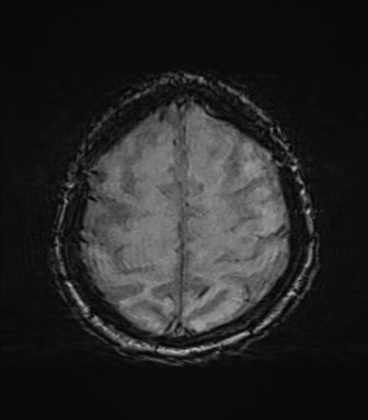 File:Behavioral variant frontotemporal dementia and late onset schizophrenia (Radiopaedia 52197-58083 Axial SWI 63).png