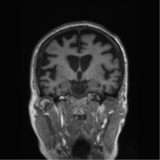 Behavioral variant frontotemporal dementia and late onset schizophrenia (Radiopaedia 52197-58083 Coronal T1 53).png