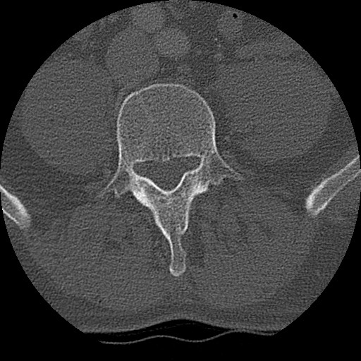 Benign post-traumatic pseudopneumoperitoneum (Radiopaedia 71199-81495 Axial bone window 257).jpg