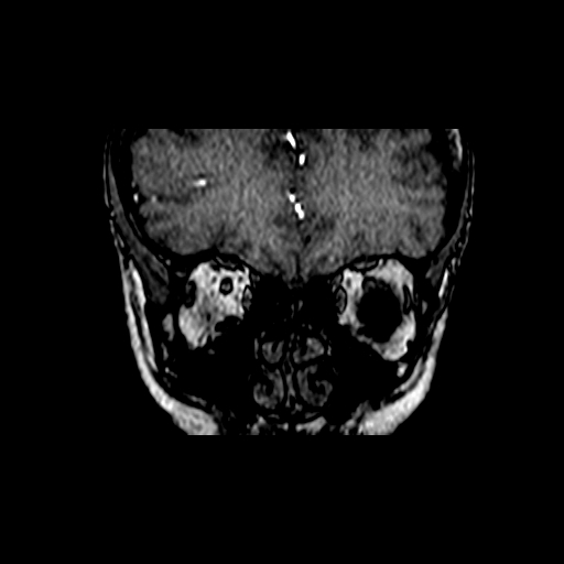 File:Berry aneurysm of the terminal internal carotid artery (Radiopaedia 88286-104918 Coronal TOF 5).jpg