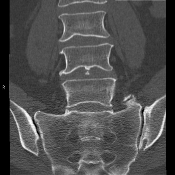Bertolotti syndrome (Radiopaedia 24864-25128 Coronal bone window 21).jpg