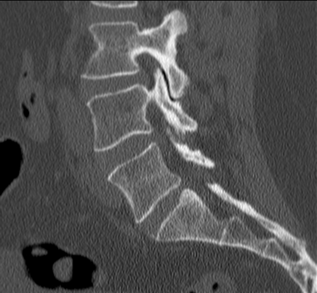 Bertolotti syndrome (Radiopaedia 24864-25128 Sagittal bone window 34).jpg