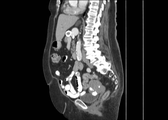 Bicameral celiacomesenteric aneurysm (Radiopaedia 55766-62327 B 28).jpg