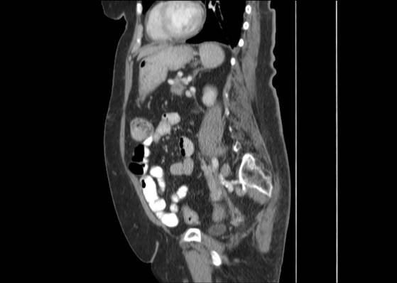 File:Bicameral celiacomesenteric aneurysm (Radiopaedia 55766-62327 B 37).jpg