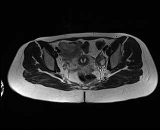File:Bicornuate bicollis uterus (Radiopaedia 61626-69616 Axial T2 22).jpg