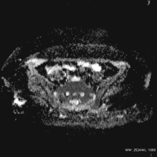 File:Bicornuate uterus- on MRI (Radiopaedia 49206-54297 Axial ADC 7).jpg