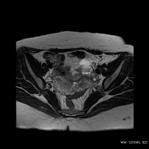 File:Bicornuate uterus- on MRI (Radiopaedia 49206-54297 Axial T2 6).jpg