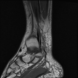 File:Bilateral Achilles tendon complete tear (Radiopaedia 81344-95051 Sagittal T1 14).jpg