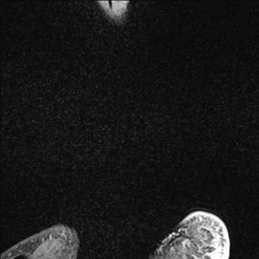 Bilateral Achilles tendon complete tear (Radiopaedia 81344-95051 Sagittal WE - Left 6).jpg