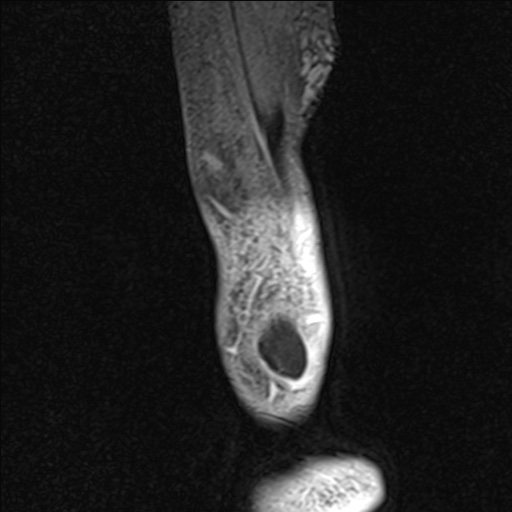 Bilateral Achilles tendon complete tear (Radiopaedia 81344-95051 Sagittal WE - Right 12).jpg