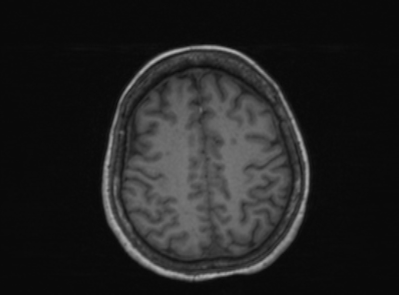 Bilateral PCA territory infarction - different ages (Radiopaedia 46200-51784 Axial T1 173).jpg